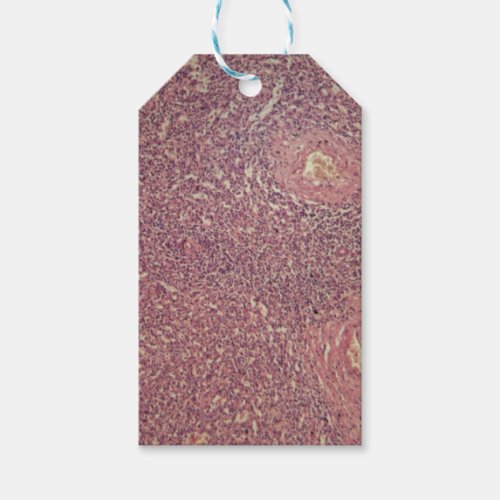 Human spleen with chronic myelogenous leukemia gift tags