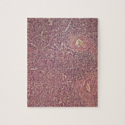 Human spleen with chronic myelogenous leukemia jigsaw puzzle