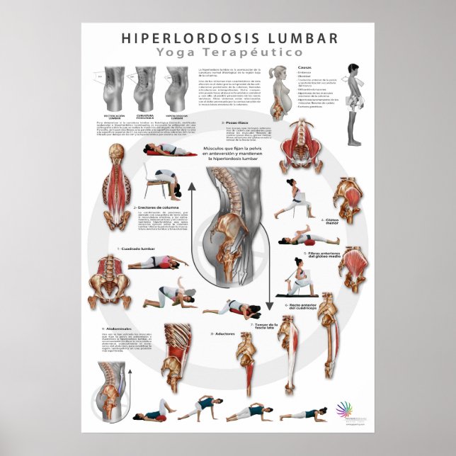 Hyperlordose - definition, causes and treatment poster (Front)