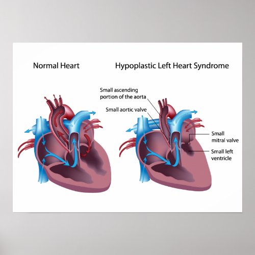 Hypoplastic left heart syndrome Poster