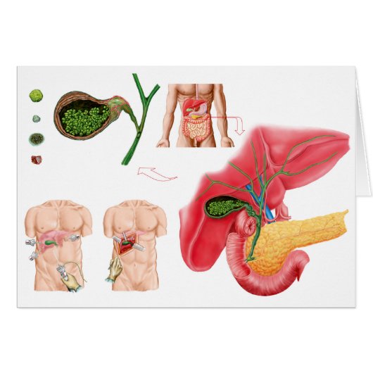 Illustration Depicting Cholecystectomy Cards (Front Horizontal)