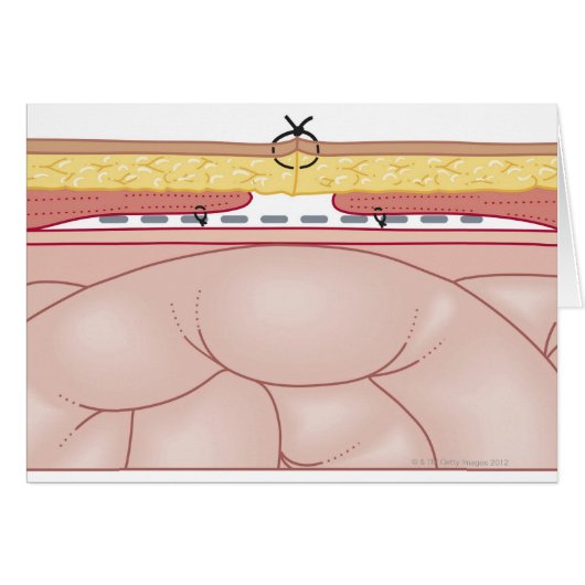 Illustration of a Hernia Cards (Front Horizontal)