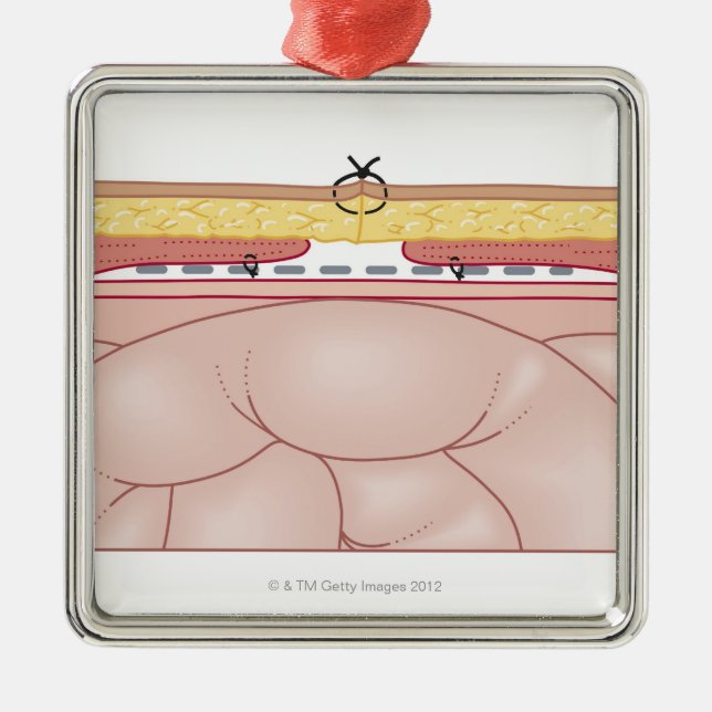 Illustration of a Hernia Metal Ornament (Front)