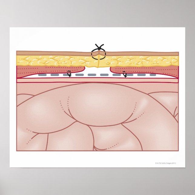 Illustration of a Hernia Poster (Front)