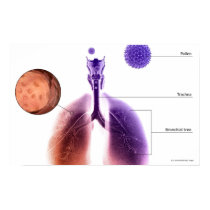 Illustration of an asthma attack from pollen poster