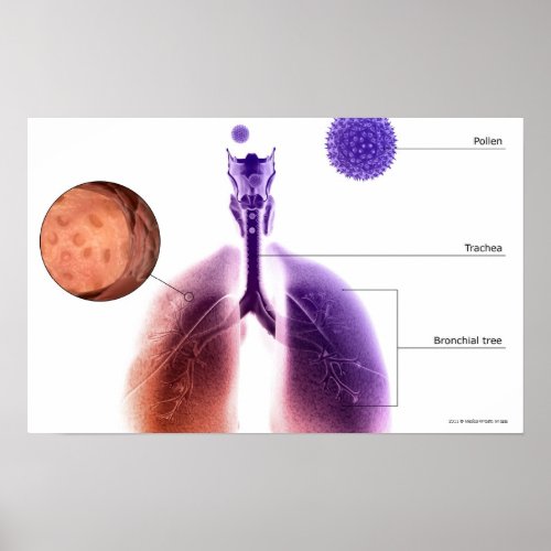 Illustration of an asthma attack from pollen poster