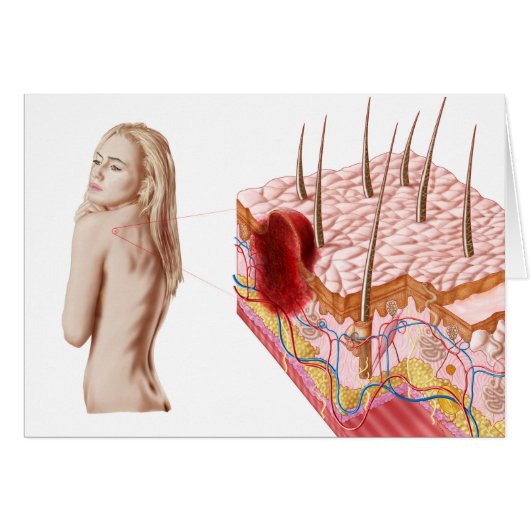 Illustration Of An Atypical Growth On The Skin (Front Horizontal)