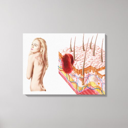 Illustration Of An Atypical Growth On The Skin Canvas Print