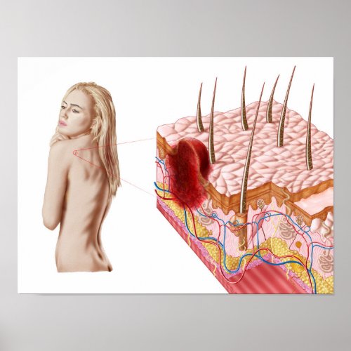 Illustration Of An Atypical Growth On The Skin Poster