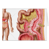 Illustration Of Diverticulosis In The Colon (Front Horizontal)
