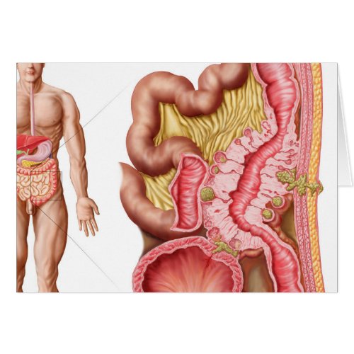 Illustration Of Diverticulosis In The Colon
