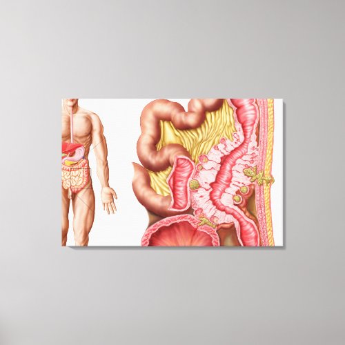 Illustration Of Diverticulosis In The Colon Canvas Print