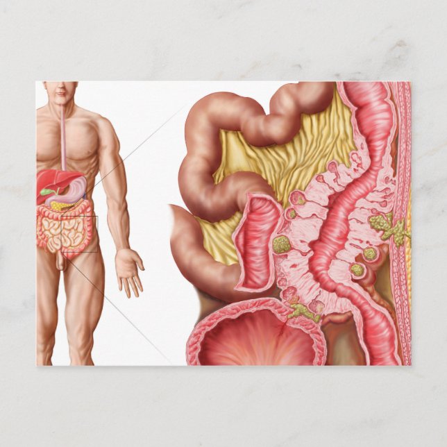 Illustration Of Diverticulosis In The Colon Postcard (Front)