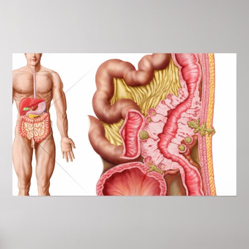 Illustration Of Diverticulosis In The Colon Poster