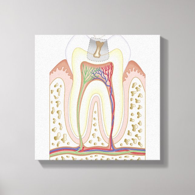 Illustration of Tooth Decay Canvas Print (Front)
