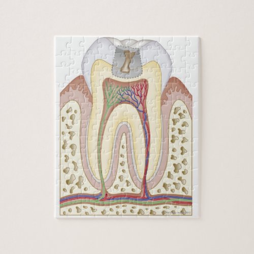 Illustration of Tooth Decay Jigsaw Puzzle