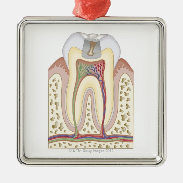 Illustration of Tooth Decay Metal Ornament (Front)