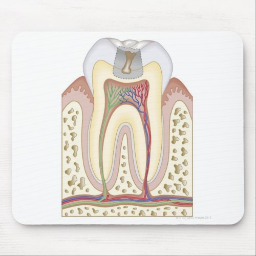 Illustration of Tooth Decay Mouse Pad