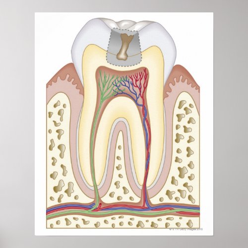 Illustration of Tooth Decay Poster