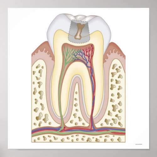 Illustration of Tooth Decay Poster