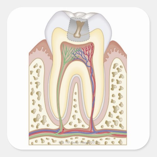 Illustration of Tooth Decay Square Sticker