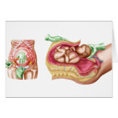 Illustration Showing Caesarean Delivery Of Fetus (Front Horizontal)