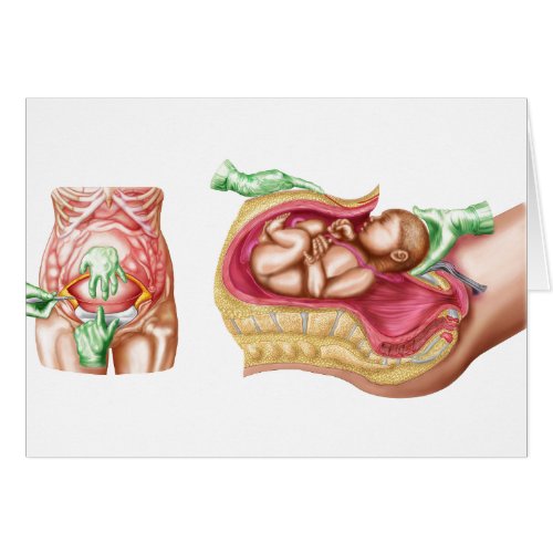 Illustration Showing Caesarean Delivery Of Fetus