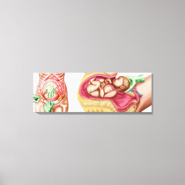 Illustration Showing Caesarean Delivery Of Fetus Canvas Print (Front)