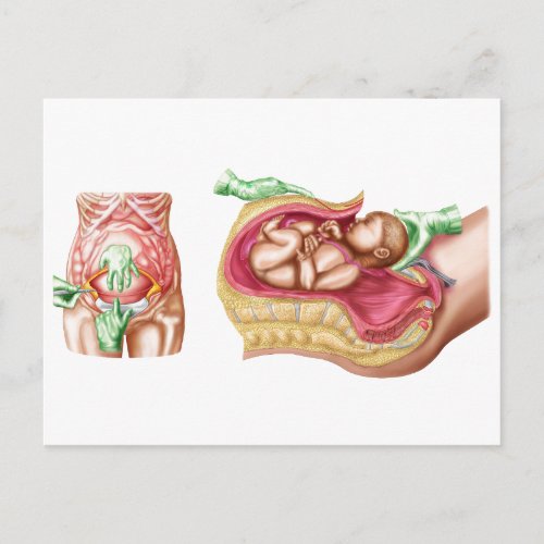 Illustration Showing Caesarean Delivery Of Fetus Postcard