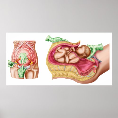Illustration Showing Caesarean Delivery Of Fetus Poster