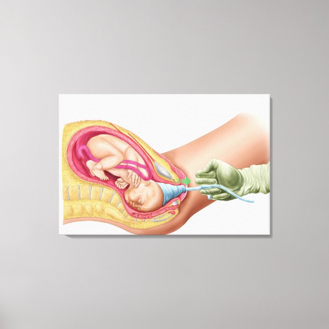 Illustration Showing Delivery Of Fetus 1 Canvas Print (Front)