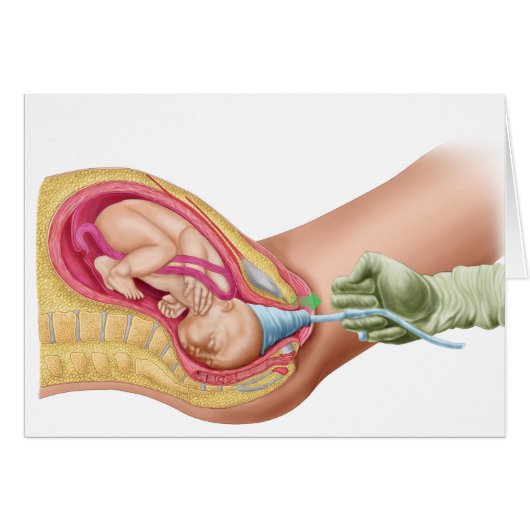 Illustration Showing Delivery Of Fetus 1 Cards (Front Horizontal)