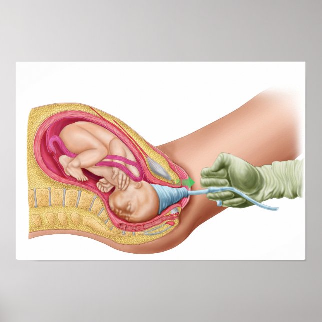 Illustration Showing Delivery Of Fetus 1 Poster (Front)