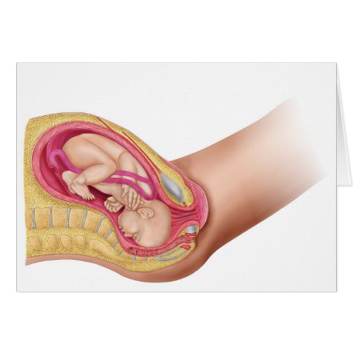 Illustration Showing Delivery Of Fetus 2