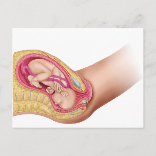 Illustration Showing Delivery Of Fetus 2 Postcard