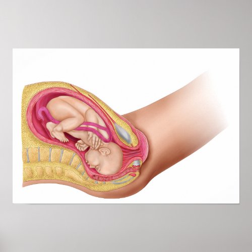 Illustration Showing Delivery Of Fetus 2 Poster