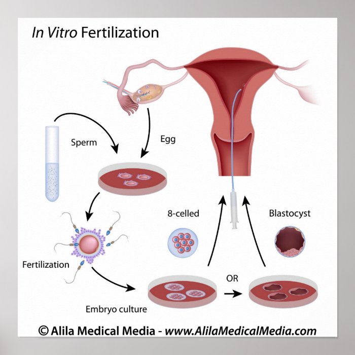 In Vitro Fertilization (IVF) procedure labeled. Poster