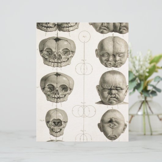 Infant Skull Deformities Weird/Conjoin Baby (Standing Front)