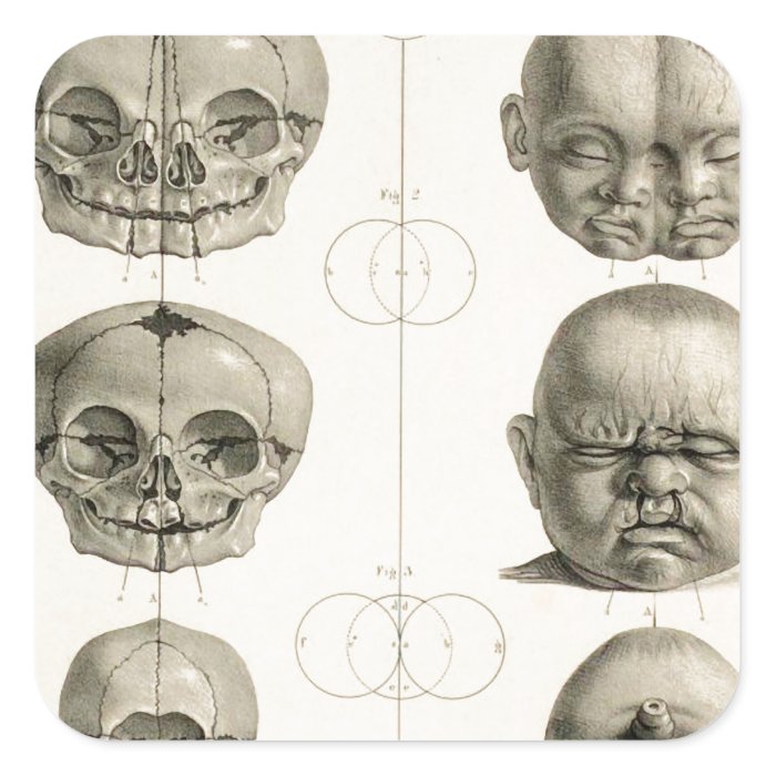 Infant Skull Deformities Weird/Conjoin Baby Square Sticker