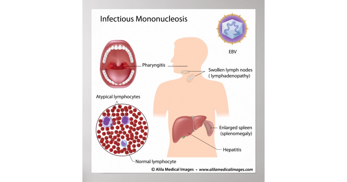 Infectious Mononucleosis, labeled diagram. Poster | Zazzle