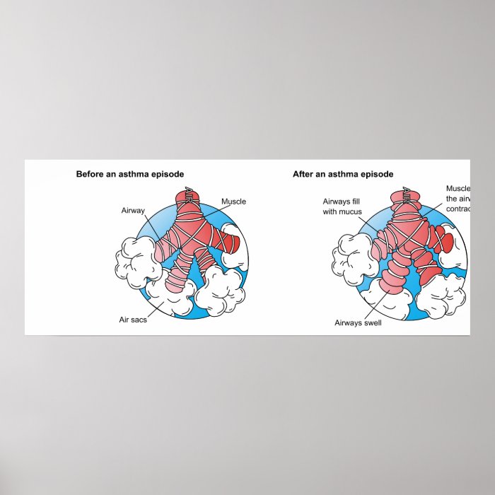 Inflamed Airways Caused by Athsma Before and After Posters