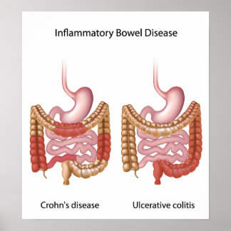 inflammatory bowel disease (ibd) poster