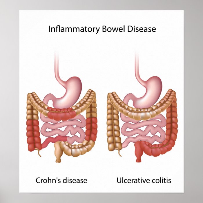 inflammatory bowel disease (ibd) poster