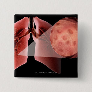 Inflammed airway during an asthma attack button