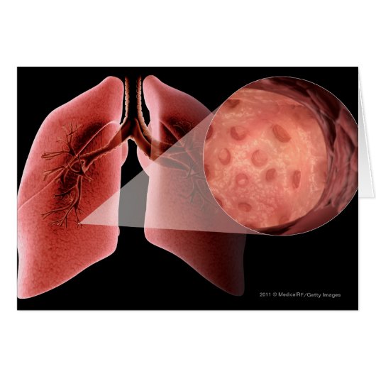 Inflammed airway during an asthma attack cards (Front Horizontal)