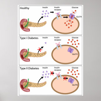 Insulin action and diabetes type 1 and 2 Poster