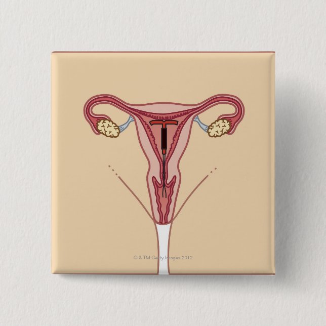 Intrauterine Device Button (Front)