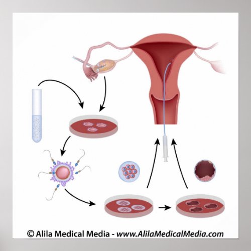 IVF procedure unlabeled diagram Poster