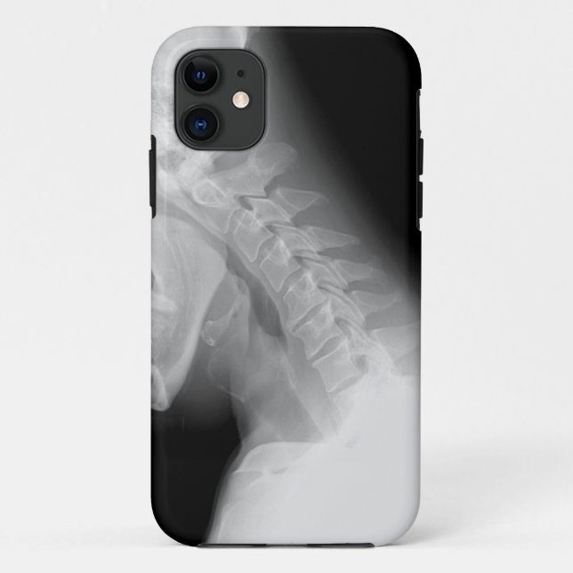 Jaw and Spine X Ray IPhone Case (Back)