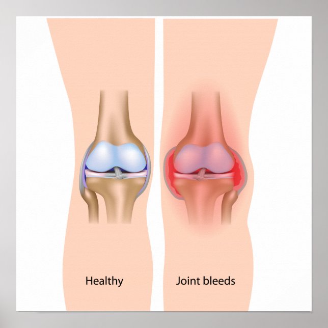 Joint bleeds in hemophilia Poster (Front)